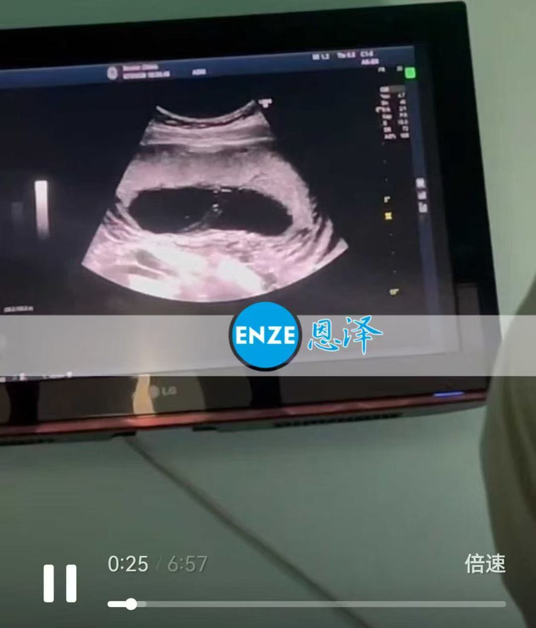 格鲁吉亚代孕代孕代母17周产检进展顺利