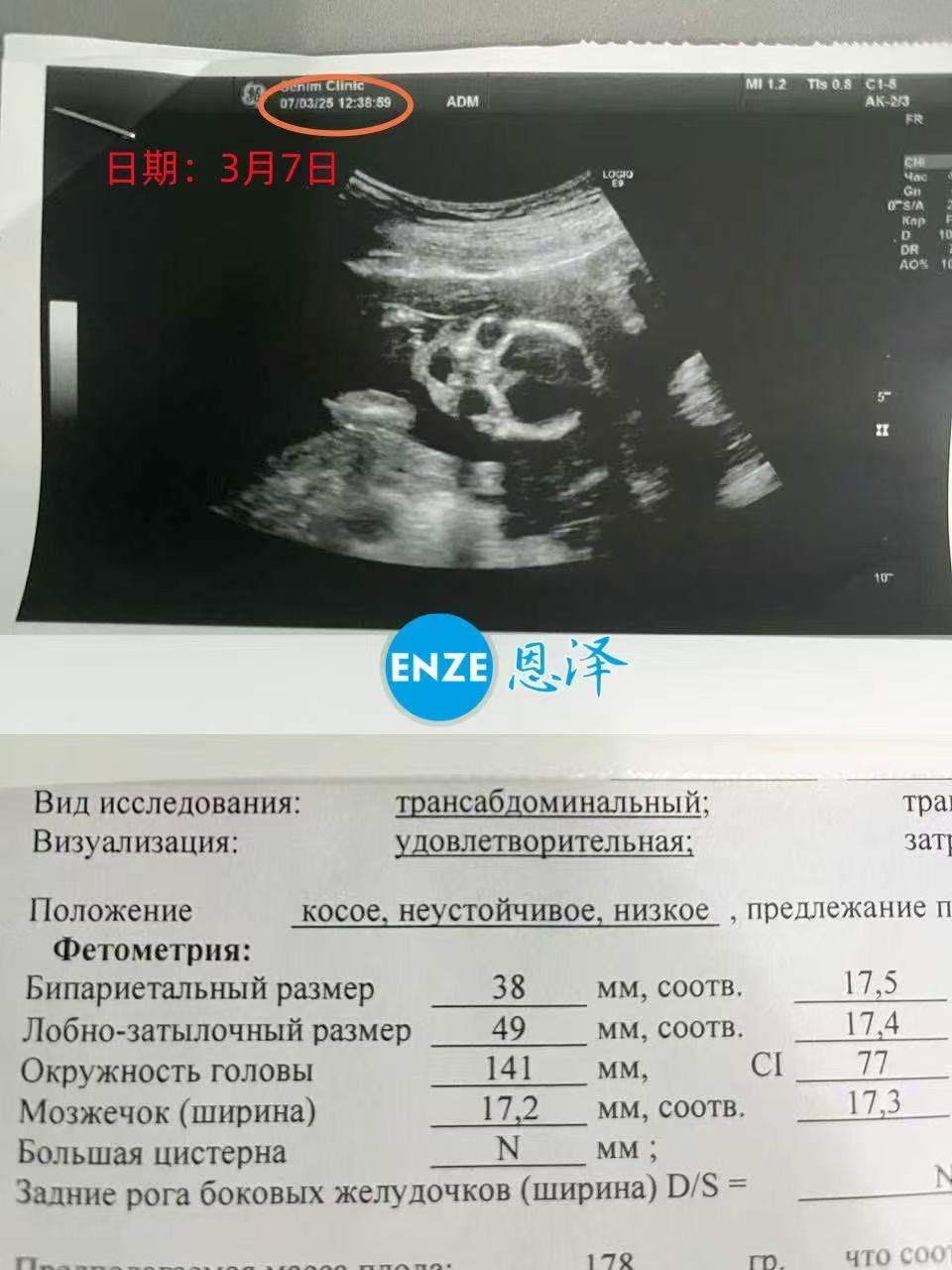 格鲁吉亚代孕代孕代母17周产检进展顺利