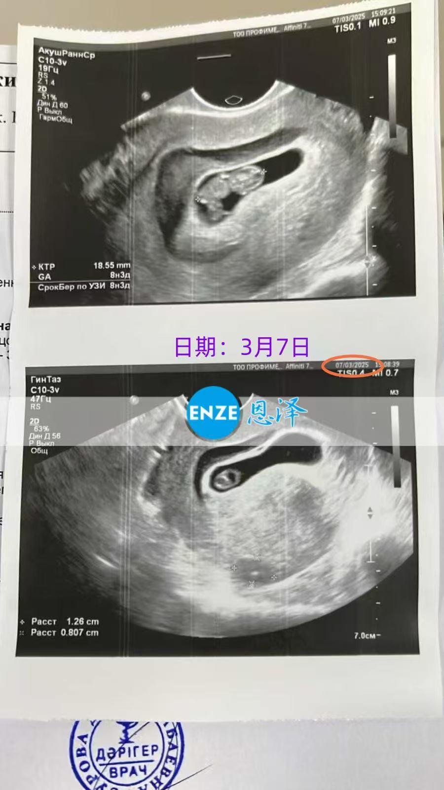 格鲁吉亚代孕代孕代母8周产检进展顺利