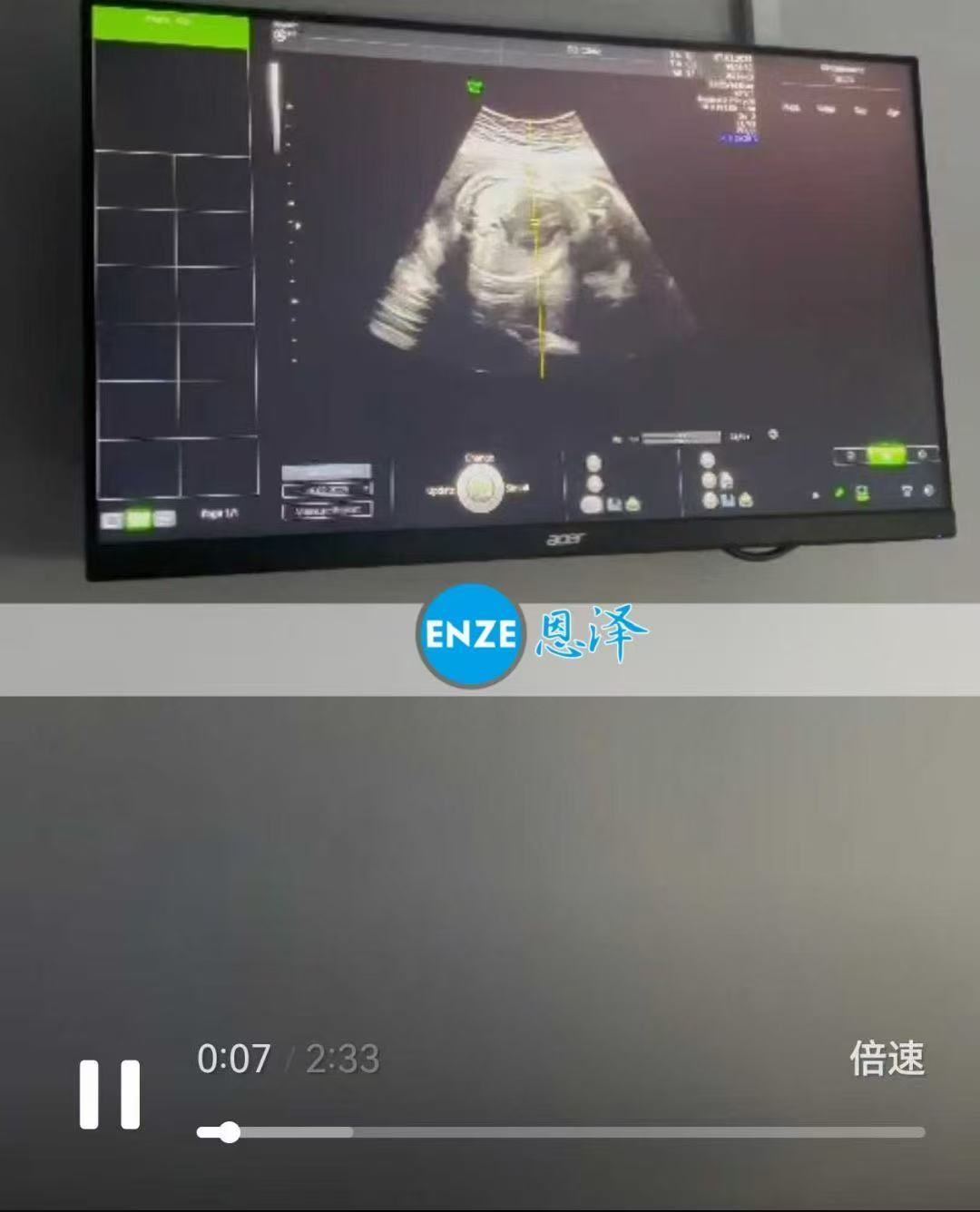 格鲁吉亚代孕代孕代母29周产检进展顺利