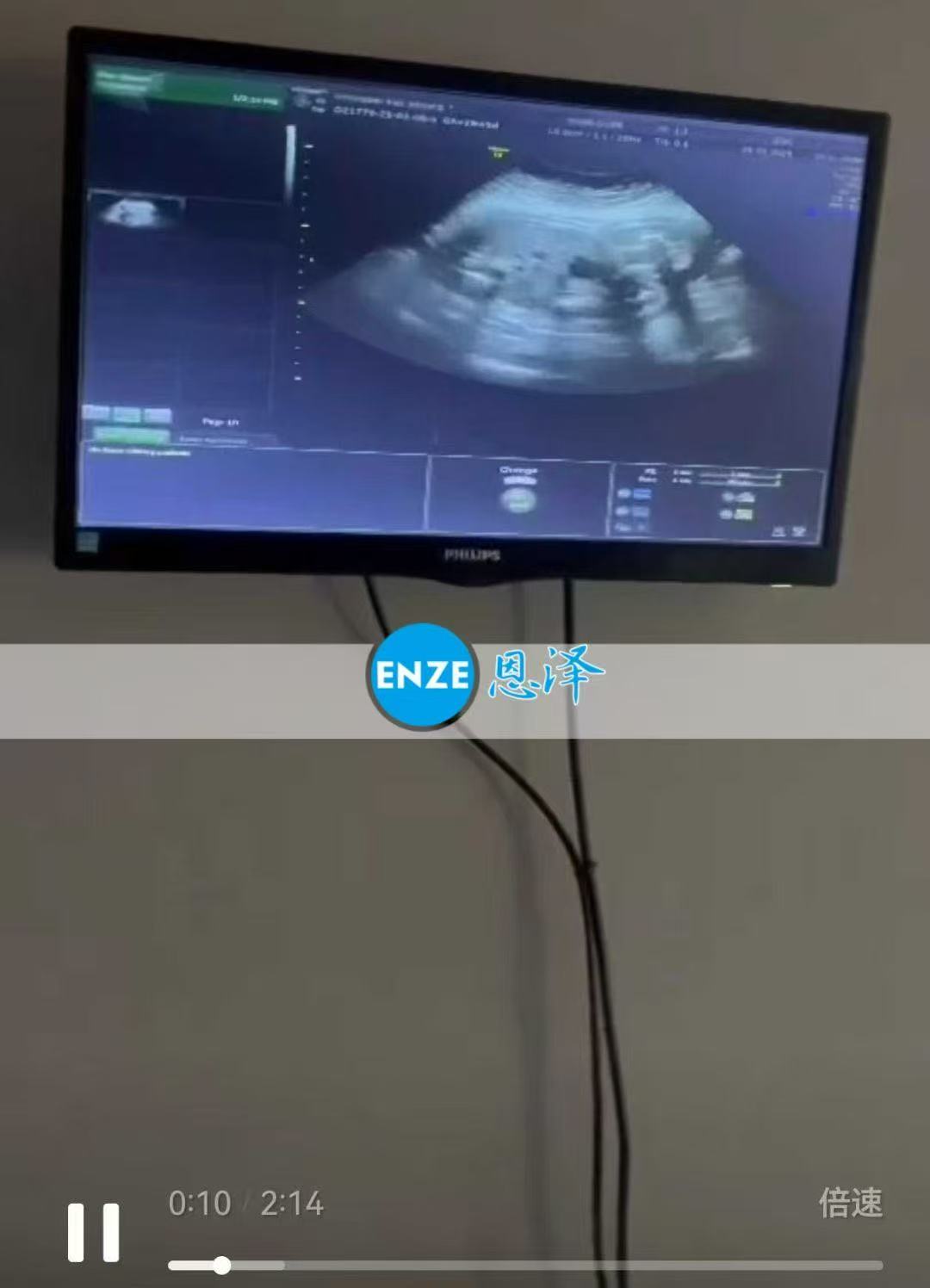 格鲁吉亚代孕代孕代母28周产检顺利通过