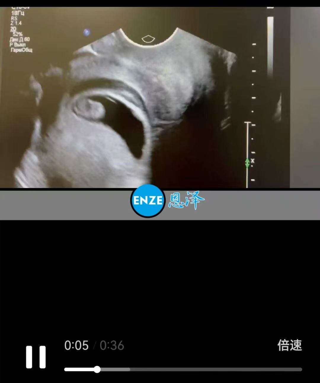 格鲁吉亚代孕代孕代母8周产检进展顺利