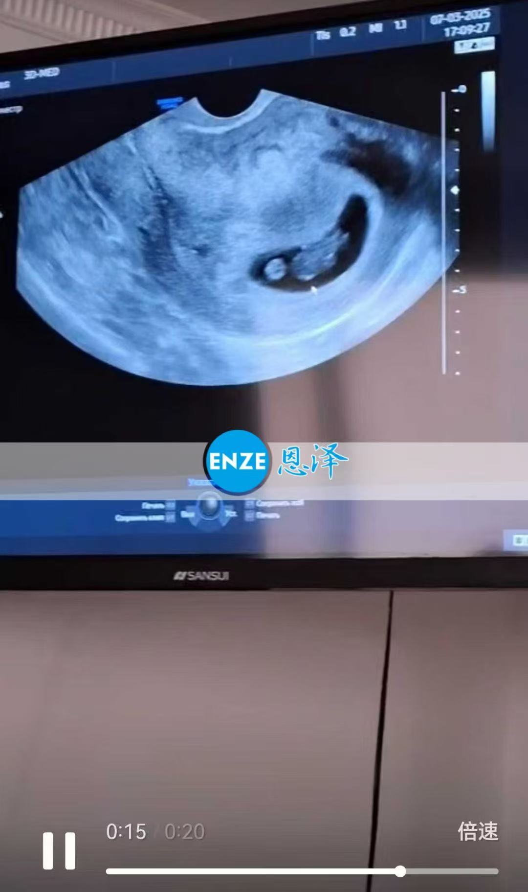 格鲁吉亚代孕代孕代母8周产检顺利通过
