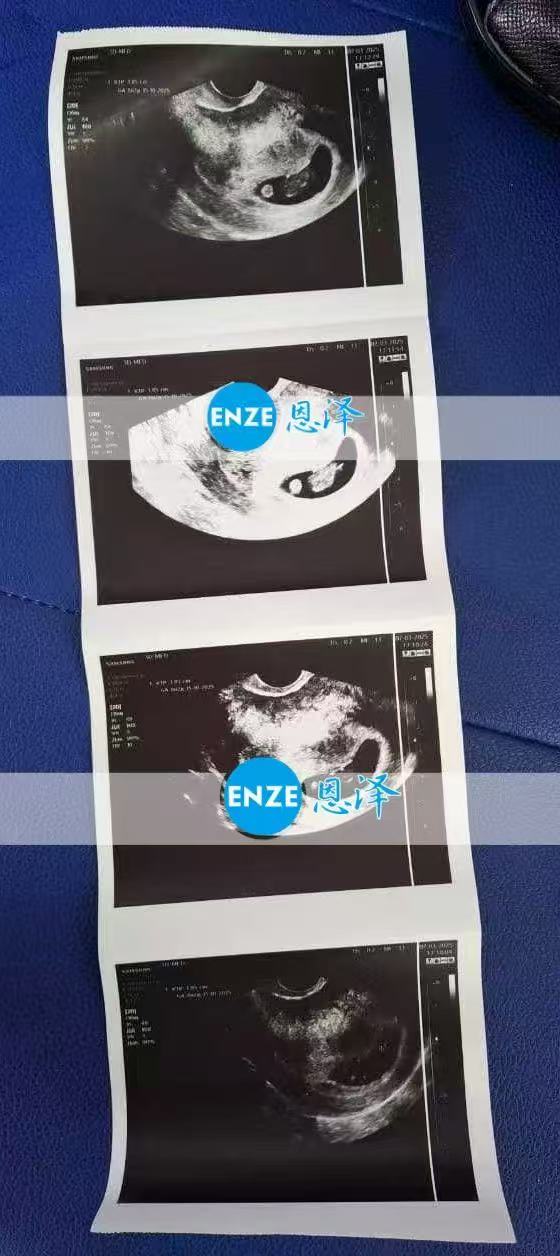 格鲁吉亚代孕代孕代母8周产检顺利通过