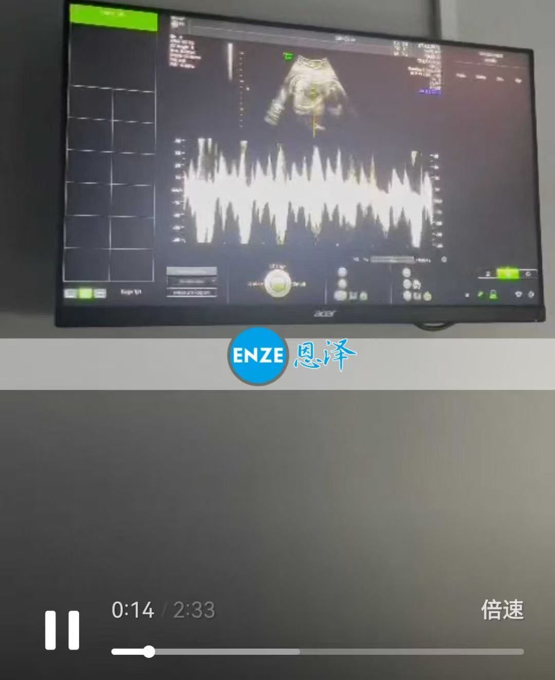 格鲁吉亚代孕代孕代母29周产检进展顺利