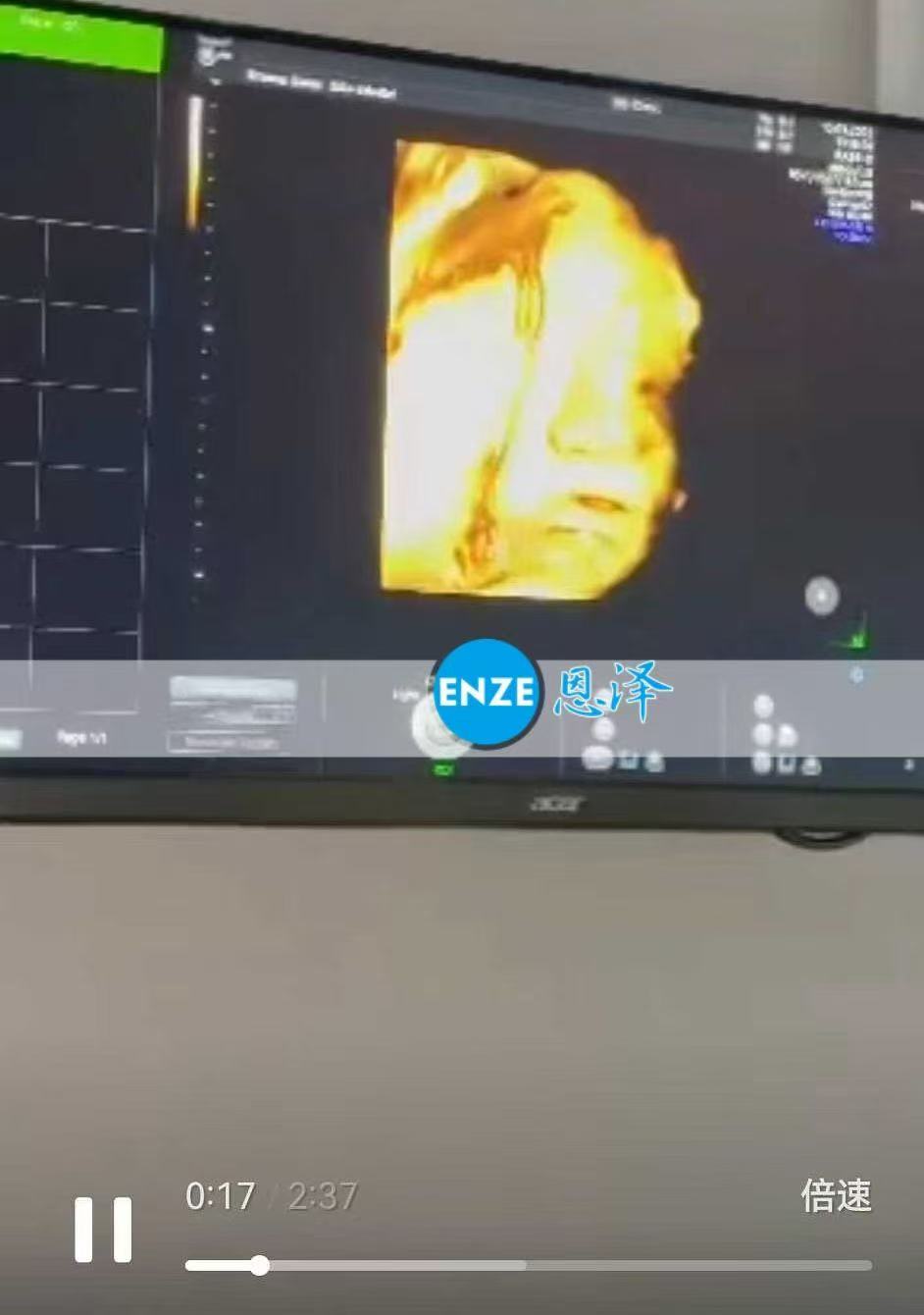 格鲁吉亚代孕代孕代母33周产检进展顺利