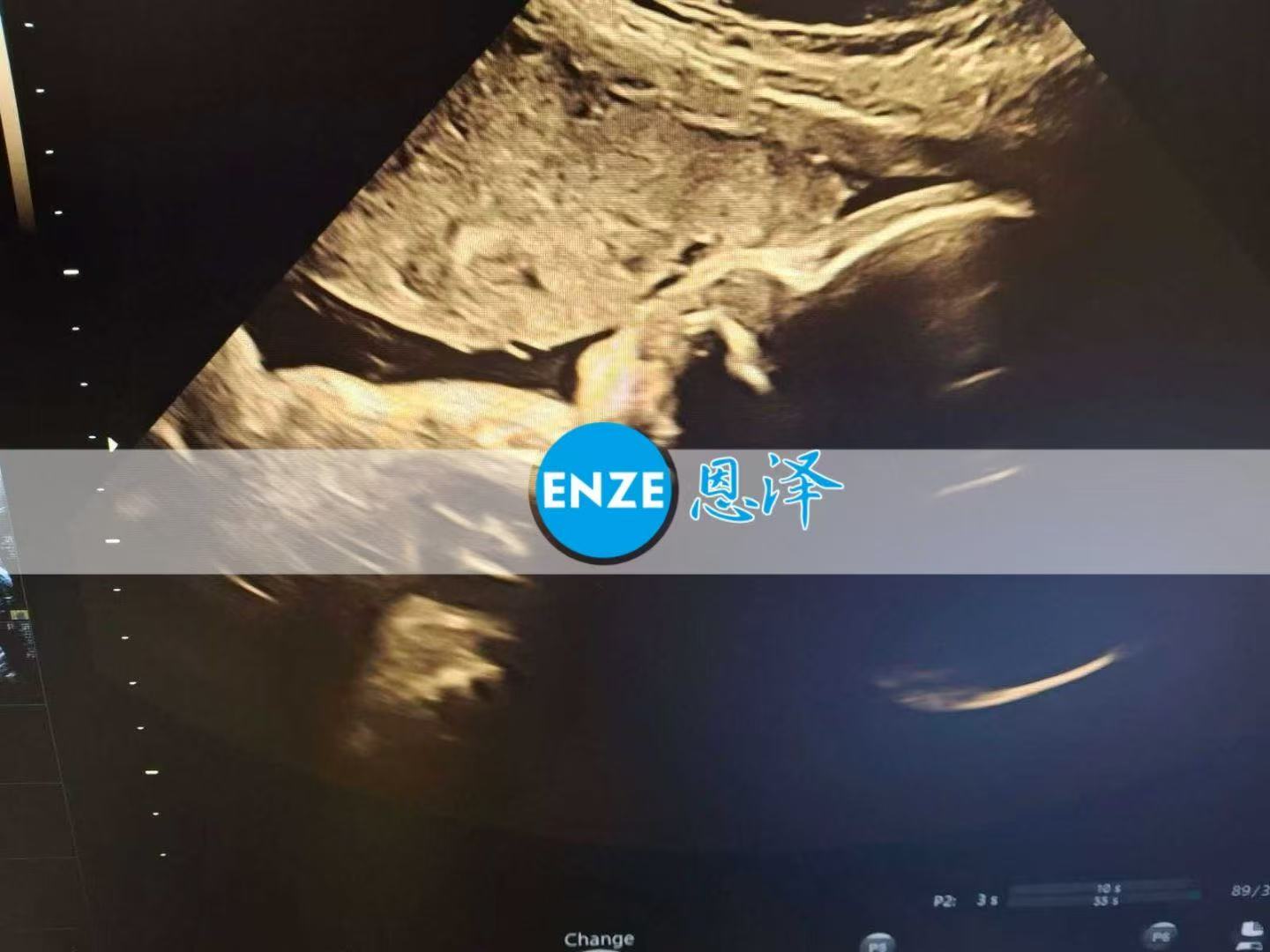 格鲁吉亚代孕代孕代母32周产检顺利通过