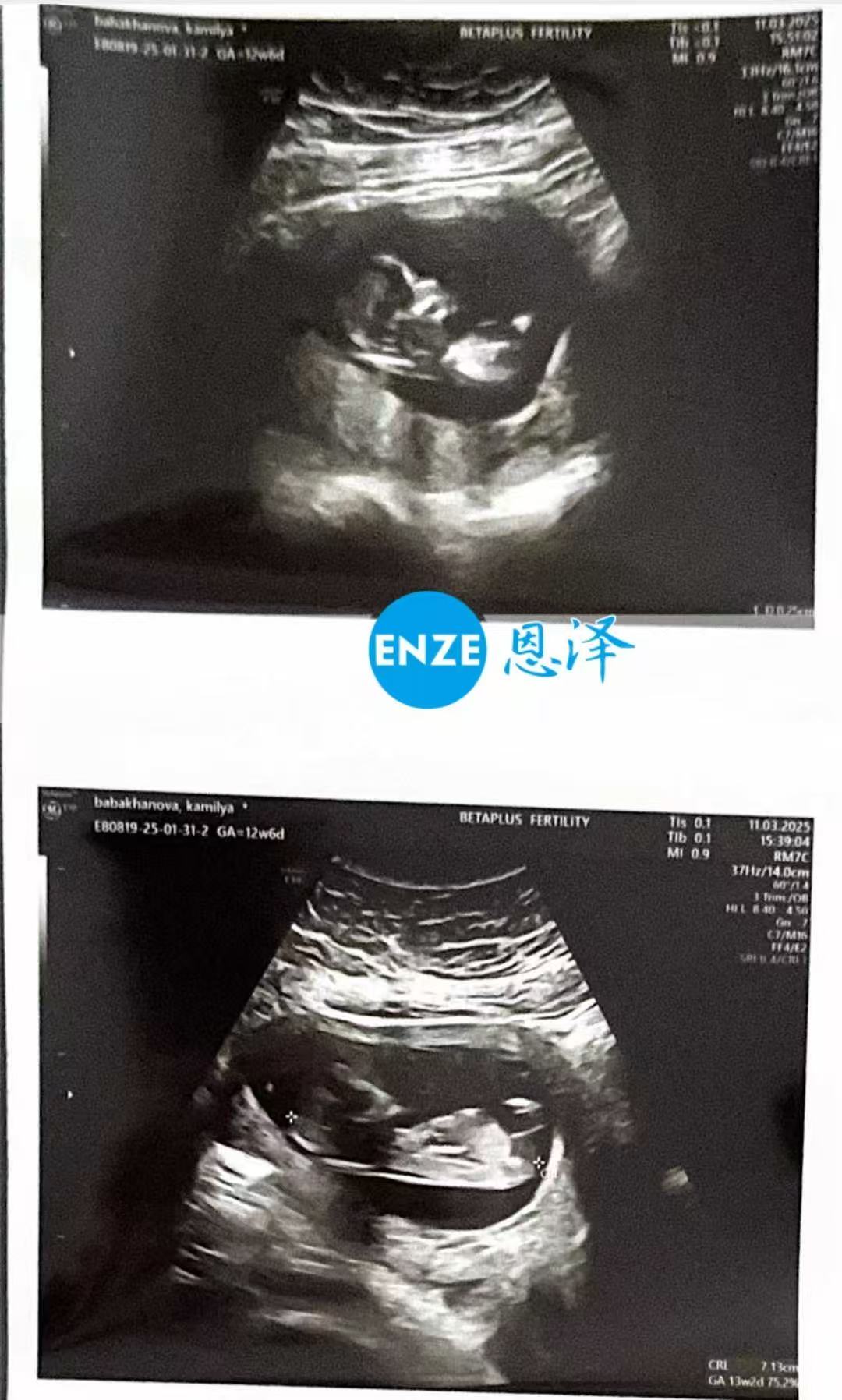 格鲁吉亚代孕代孕代母通过13周产检，正式度过风险期