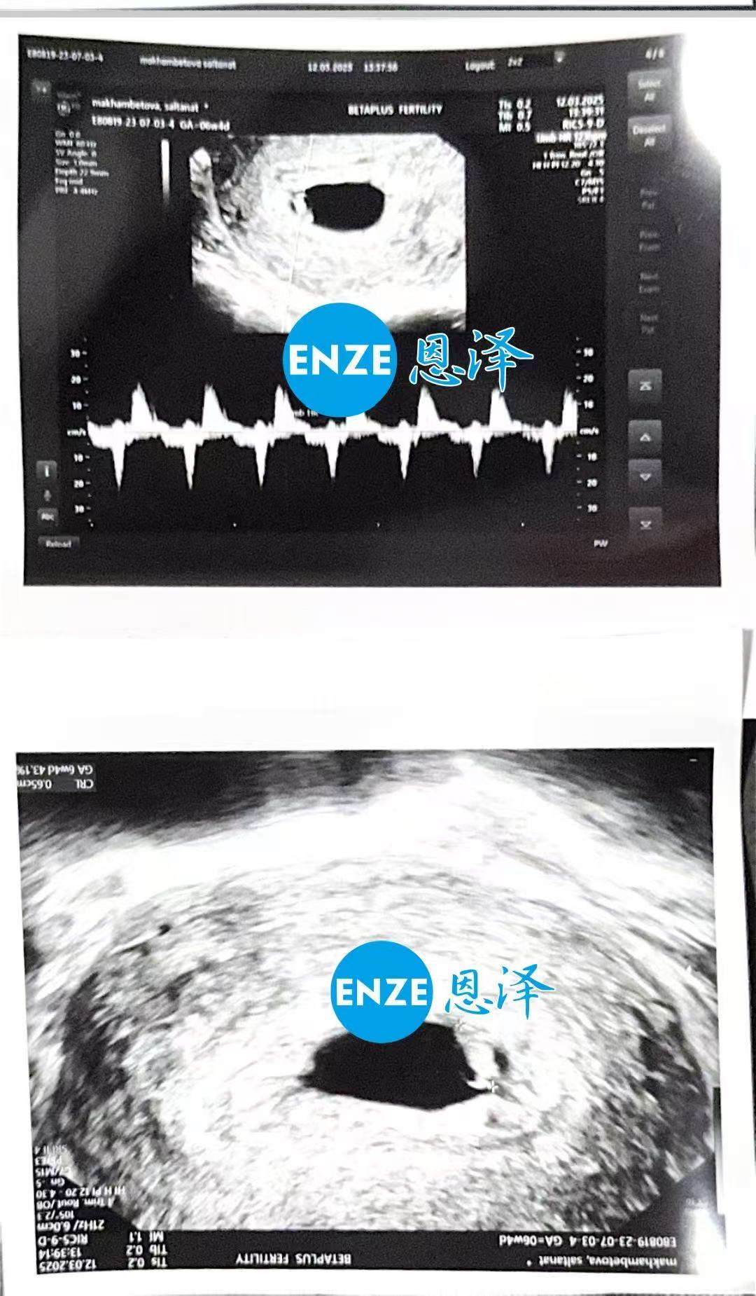 格鲁吉亚代孕代孕代母8周第一次产检顺利通过