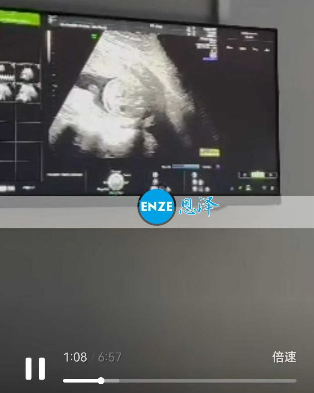 格鲁吉亚代孕代孕代母19周产检顺利通过