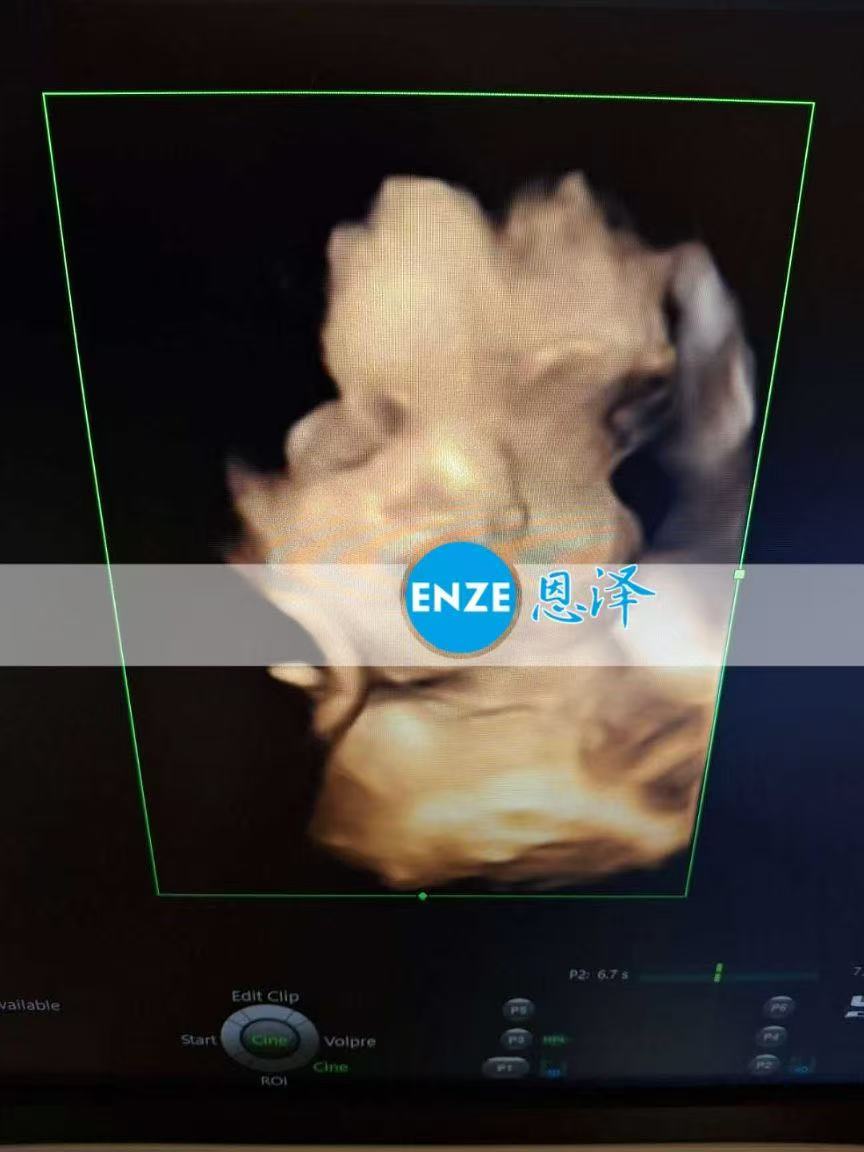格鲁吉亚代孕代孕代母32周产检顺利通过