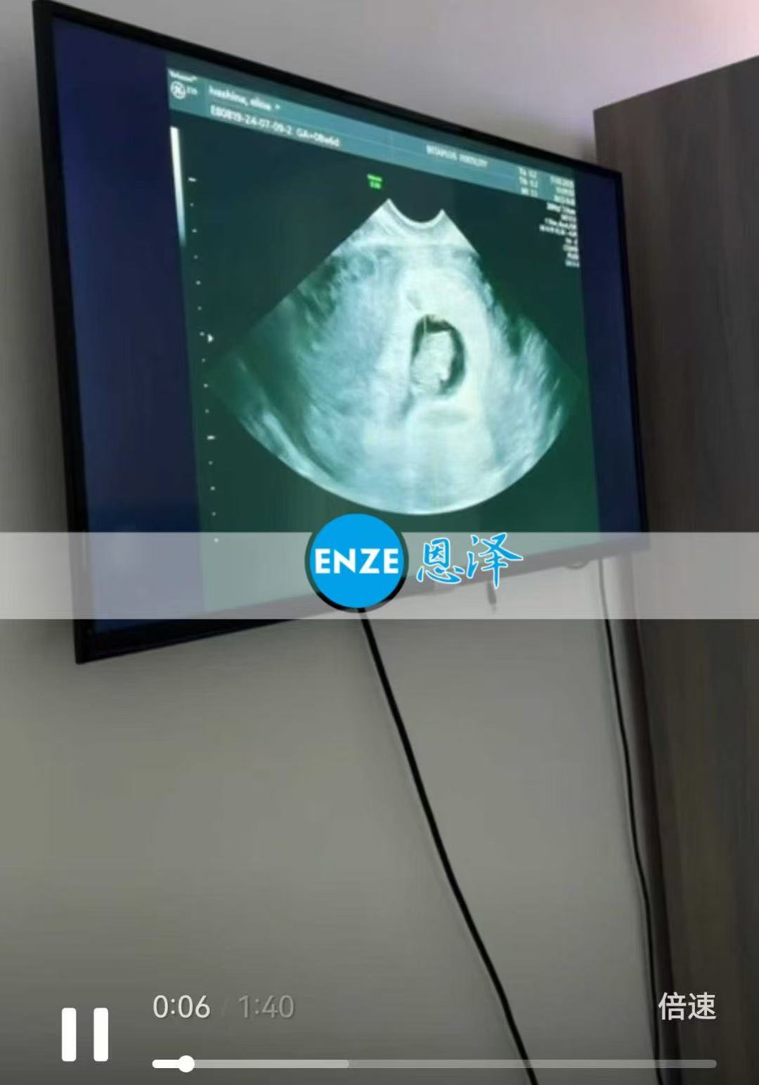格鲁吉亚代孕代孕代母8周产检顺利通过