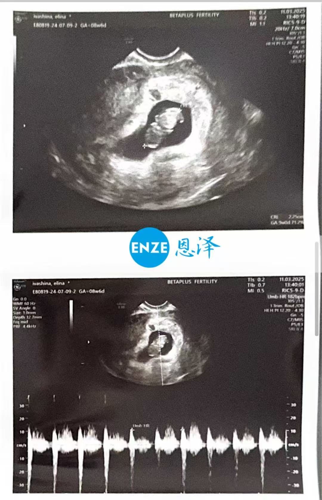 格鲁吉亚代孕代孕代母8周产检顺利通过