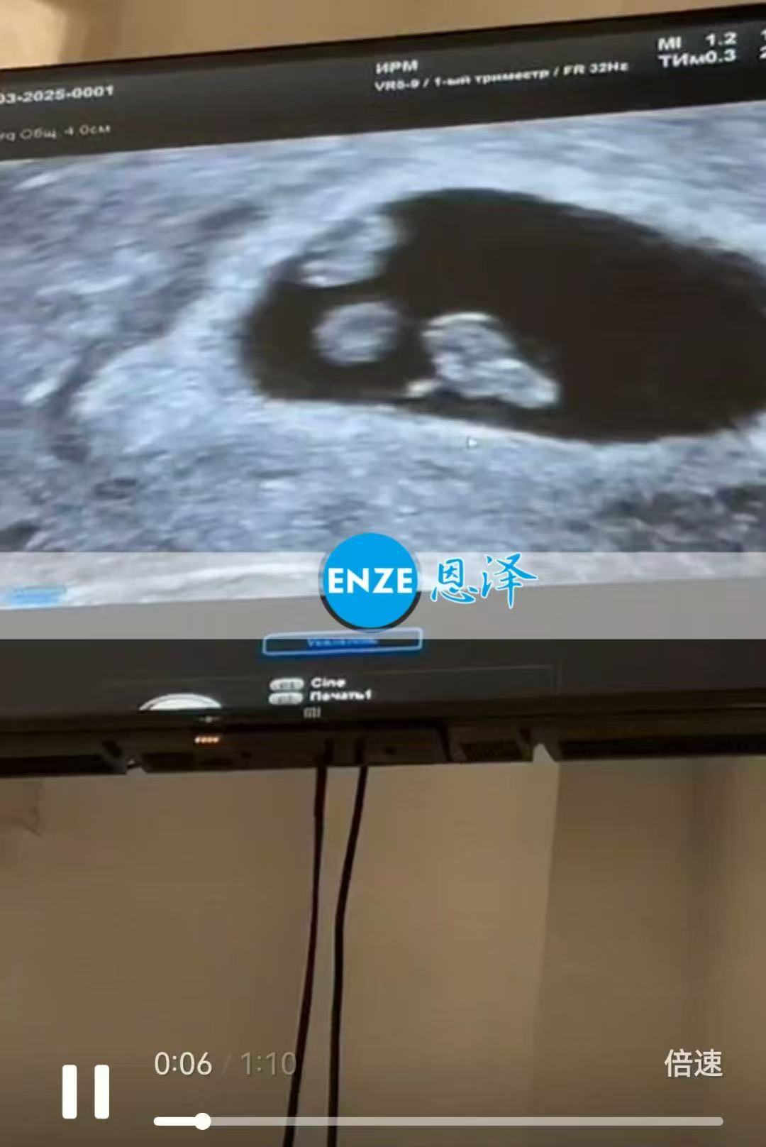 哈萨克斯坦代孕代孕代母移植胚胎分裂，孕育同卵双胞胎