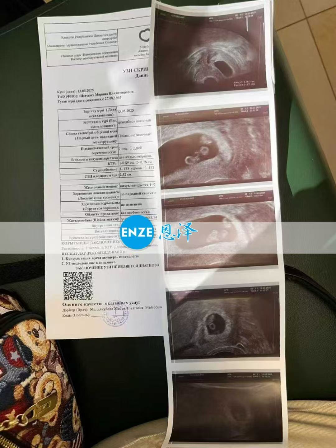哈萨克斯坦代孕代孕代母移植胚胎分裂，孕育同卵双胞胎