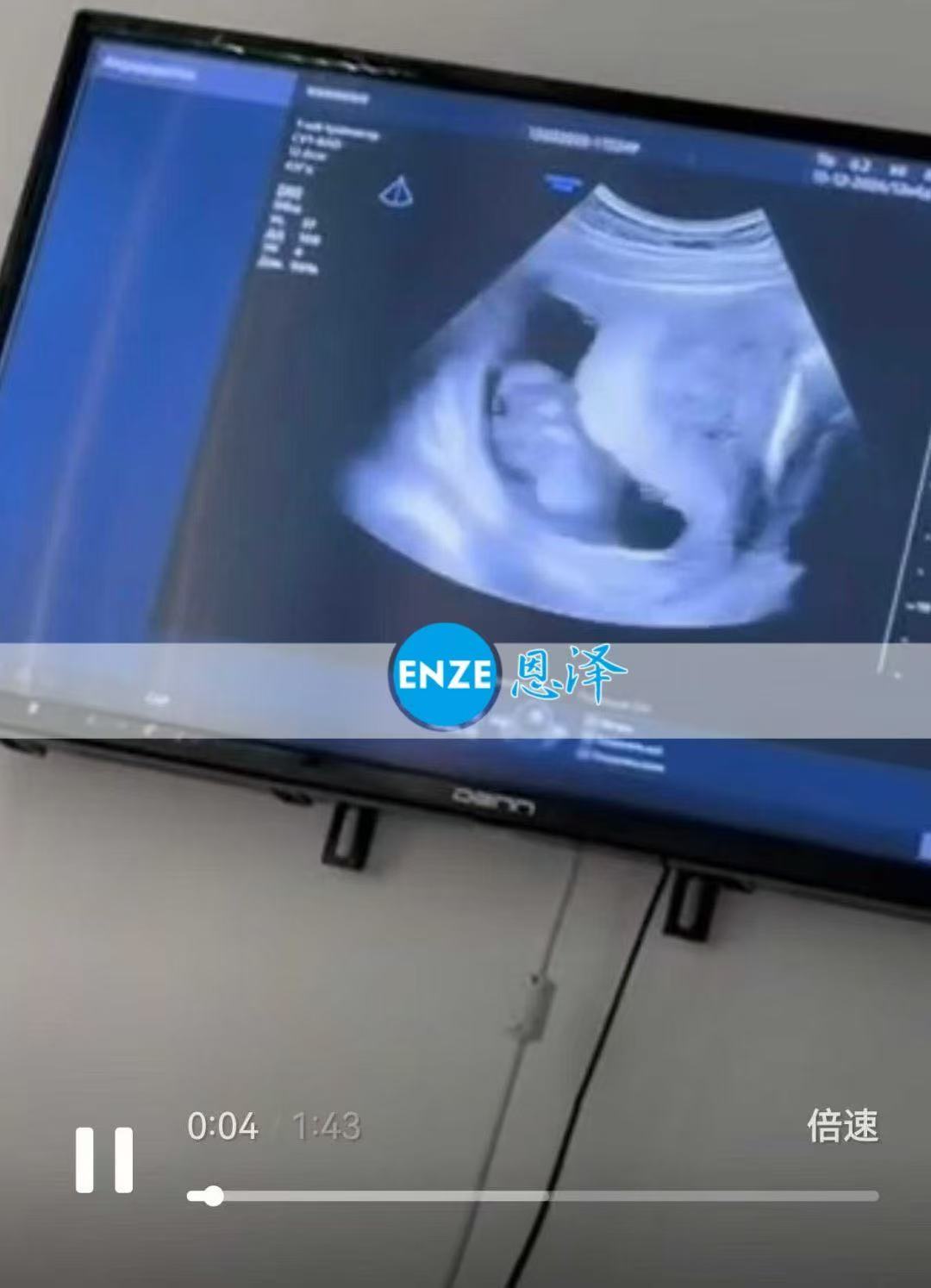 格鲁吉亚代孕代孕代母顺利通过14周产检