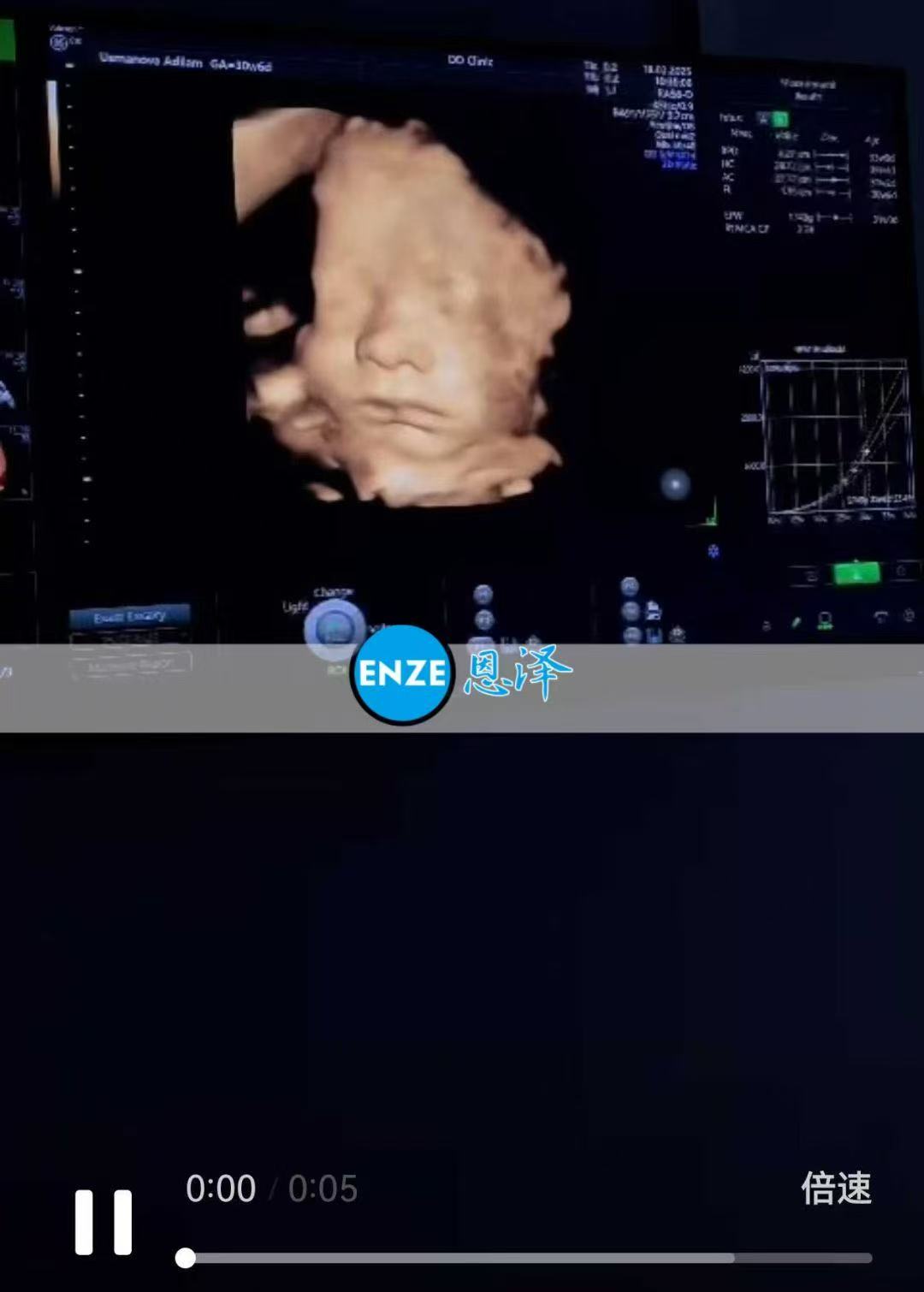 格鲁吉亚代孕代孕代母30周产检顺利通过