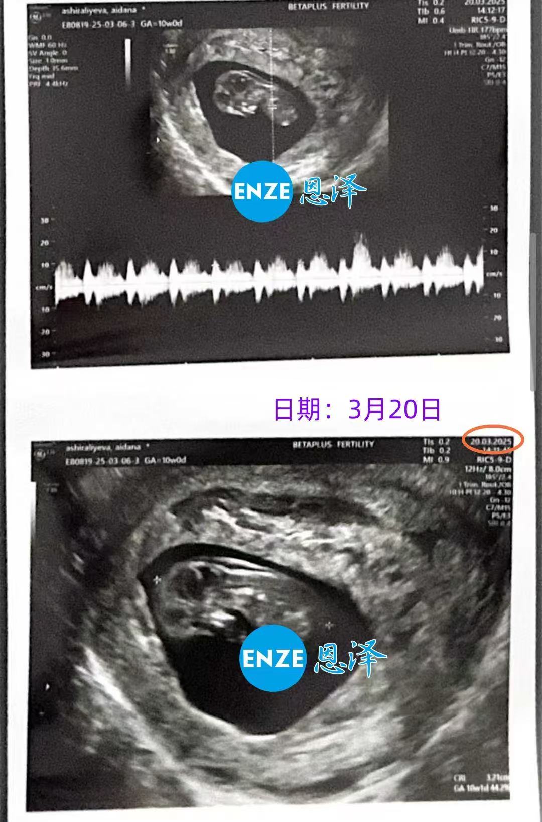 格鲁吉亚代孕代孕代母10周产检顺利过关