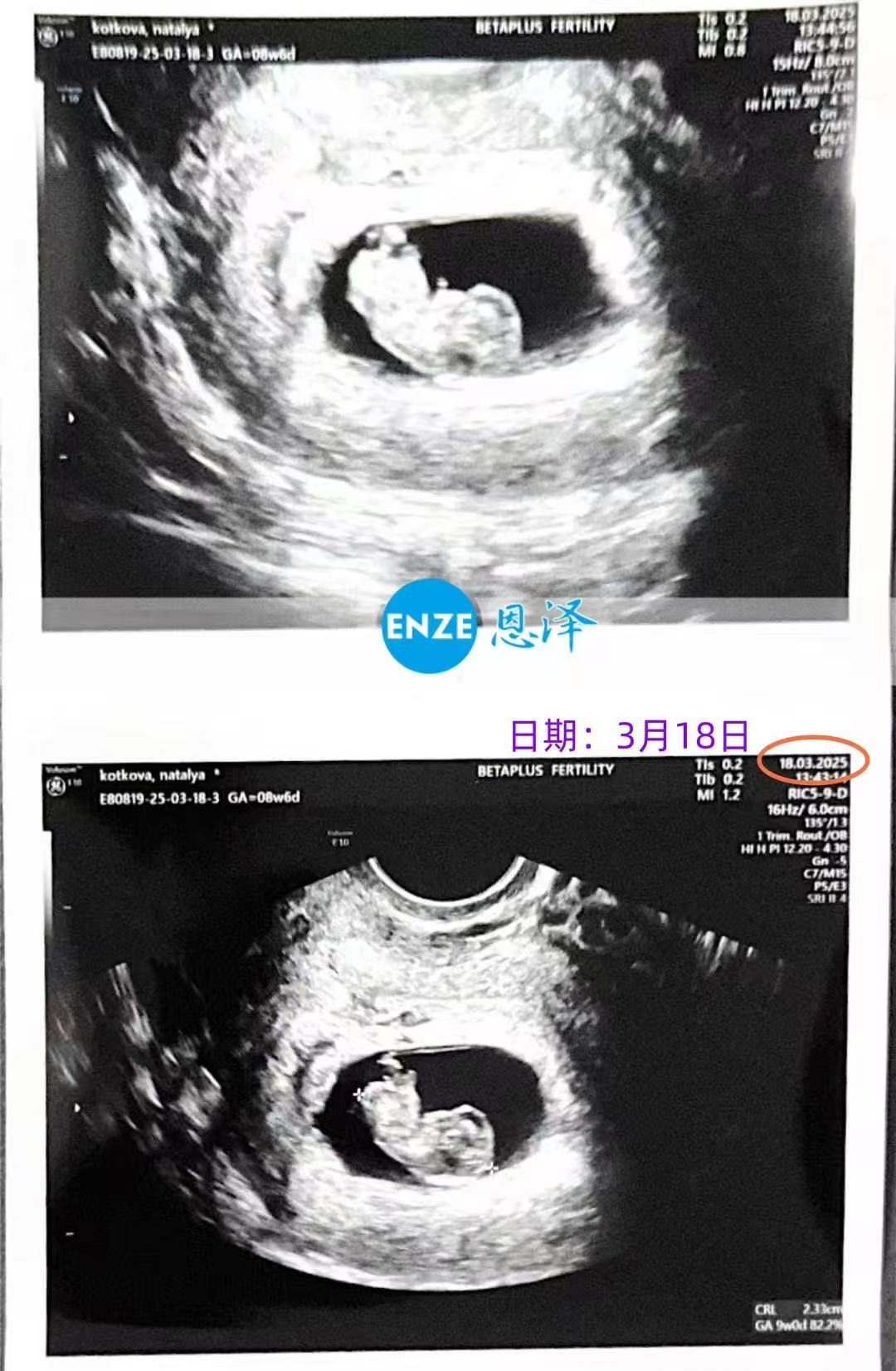 格鲁吉亚代孕代孕代母9周产检进展顺利