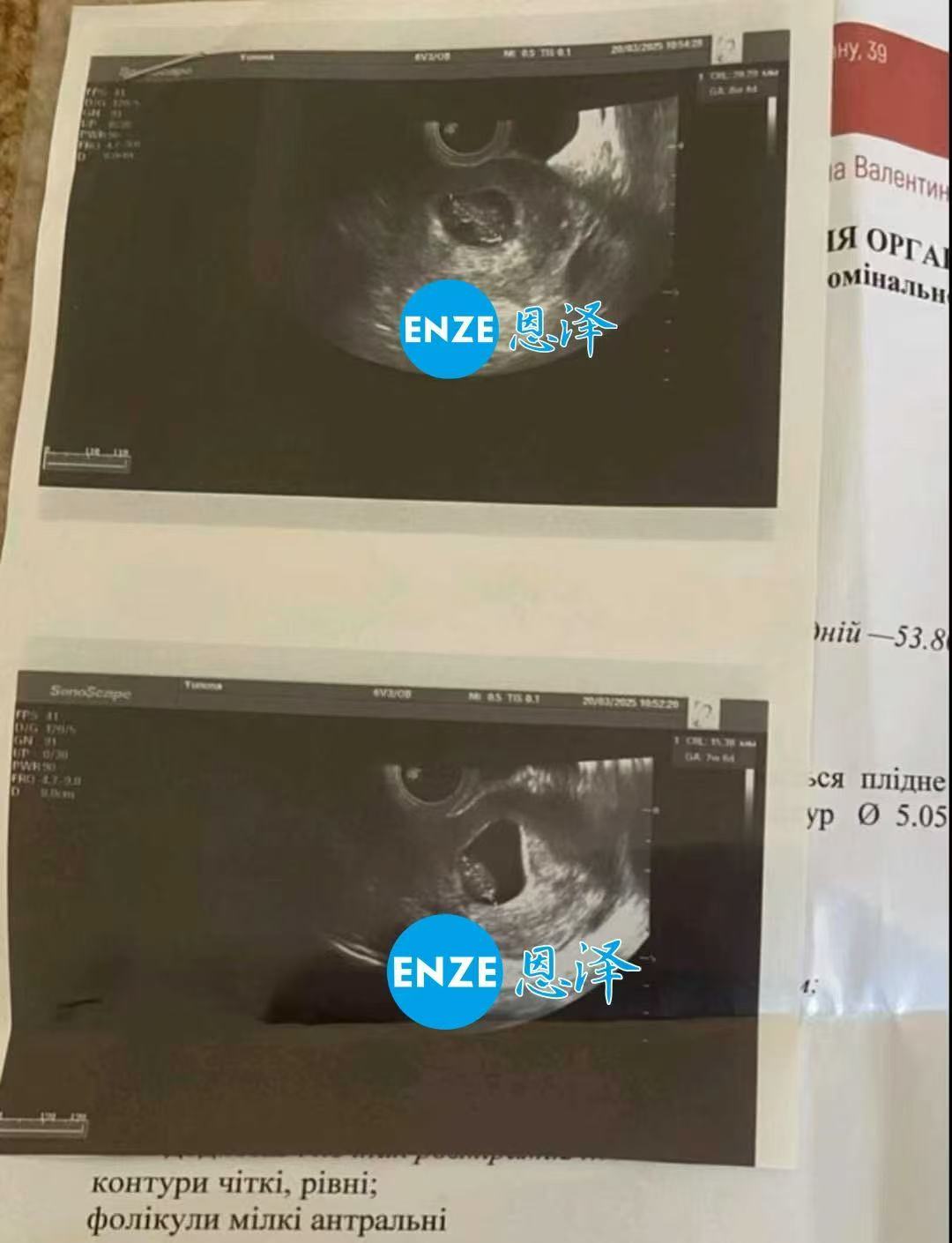 乌克兰代孕代孕代母成功通过8周产检