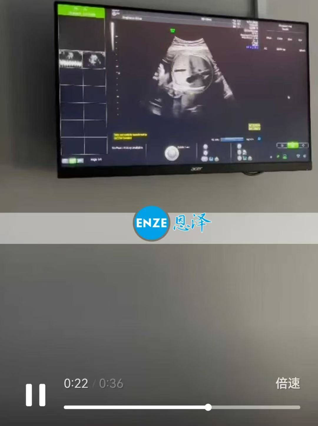 格鲁吉亚代孕代孕代母28周产检顺利通过
