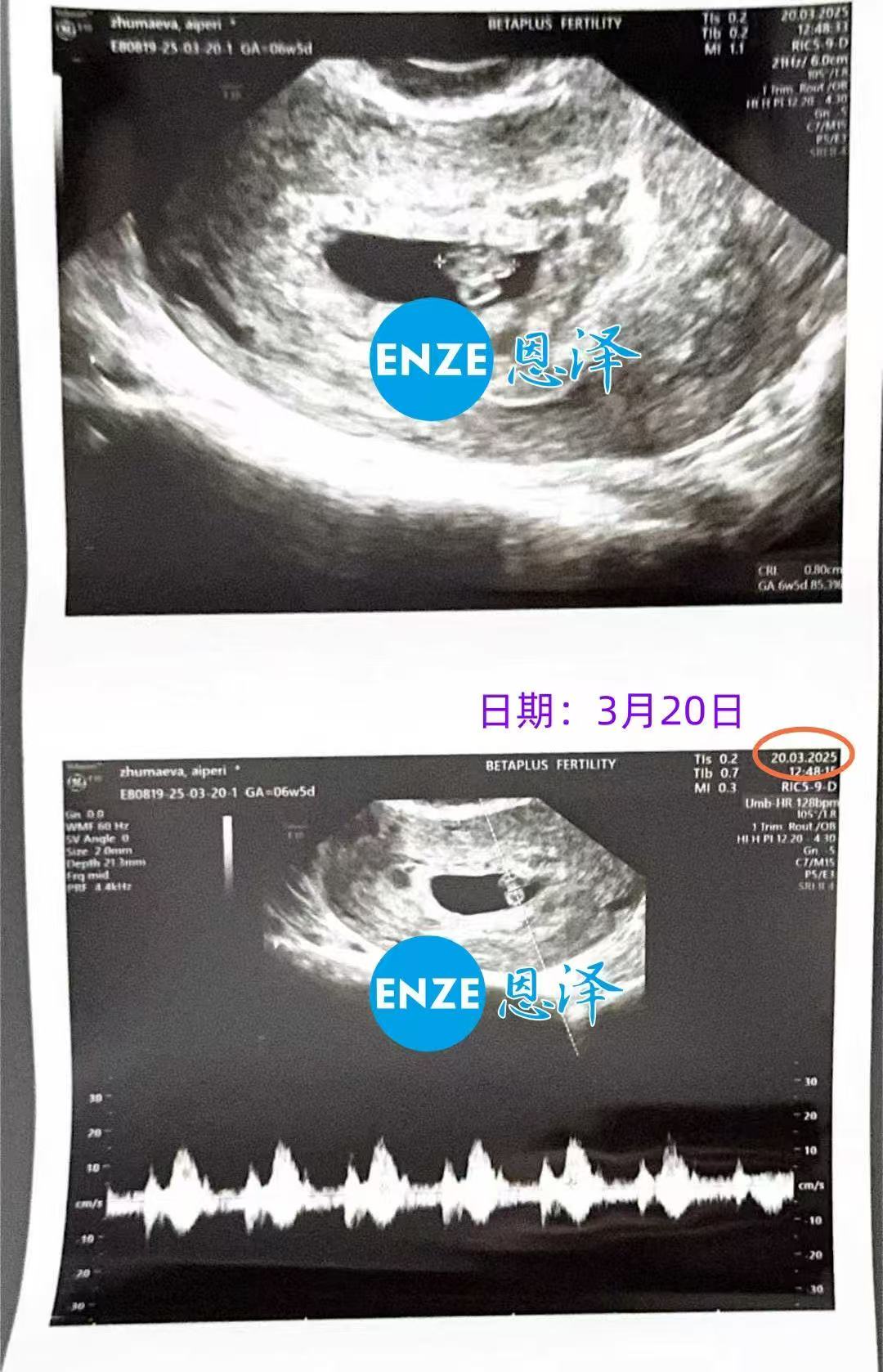 格鲁吉亚代孕代孕代母顺利通过6周产检