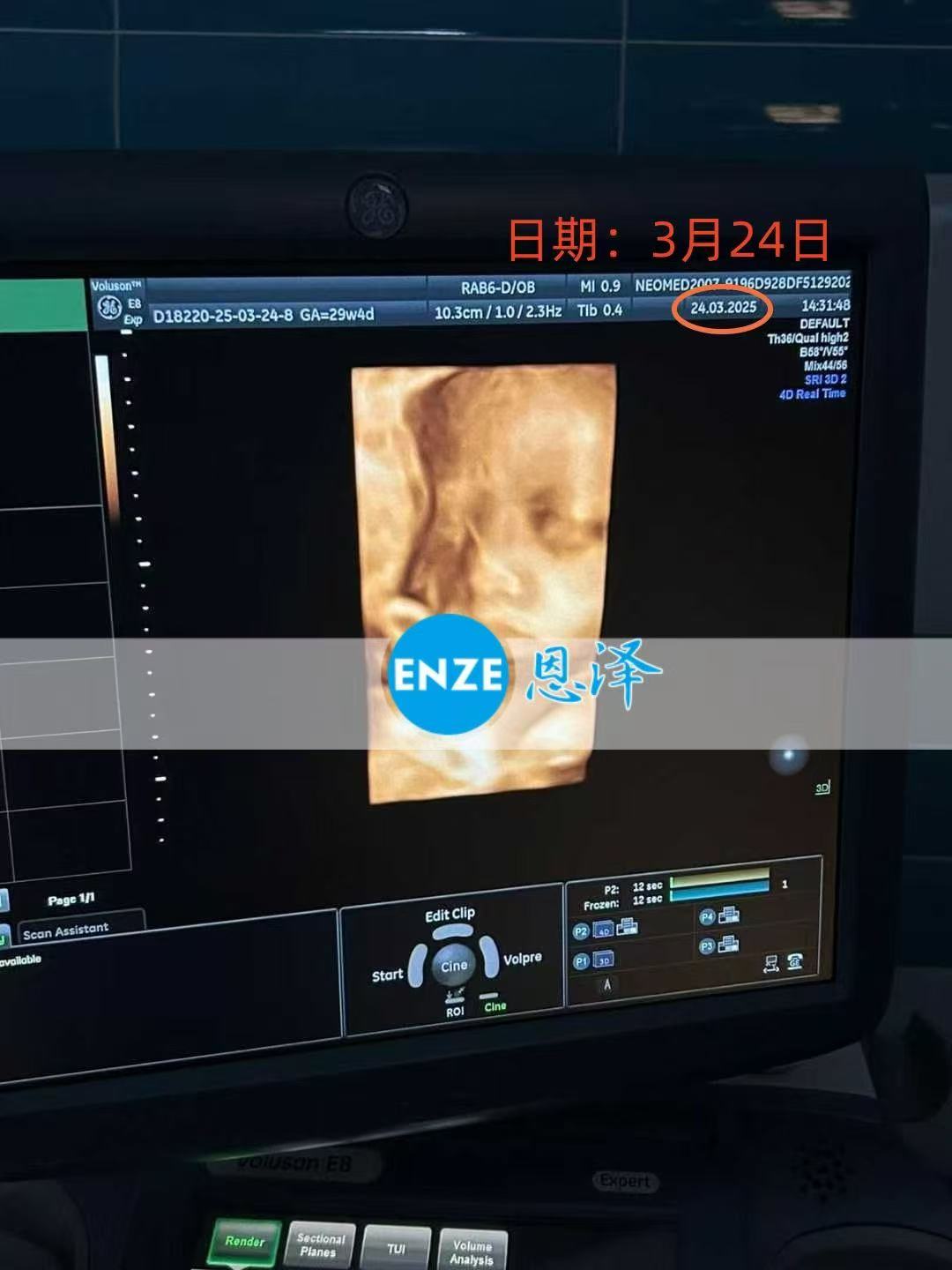乌克兰代孕代孕代母顺利通过30周产检