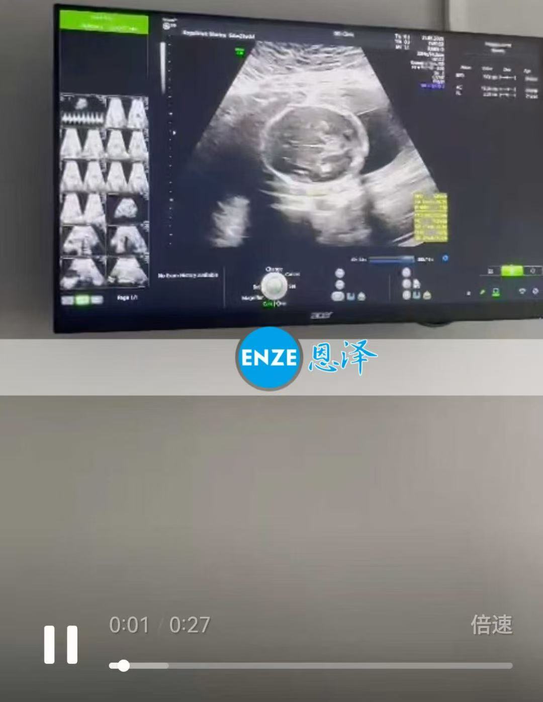 格鲁吉亚代孕代孕代母21周产检顺利通过