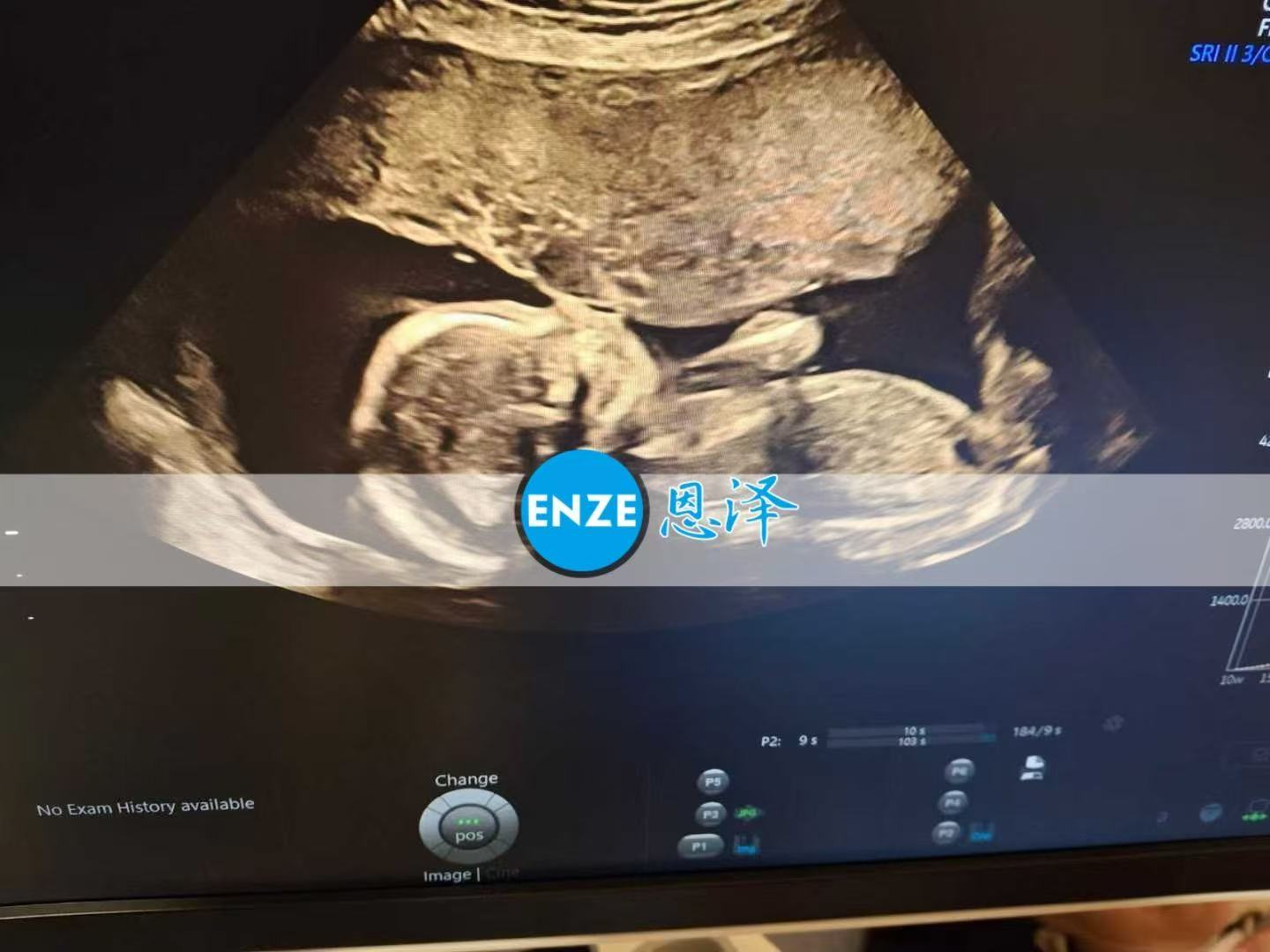 乌克兰代孕代孕代母19周产检顺利过关