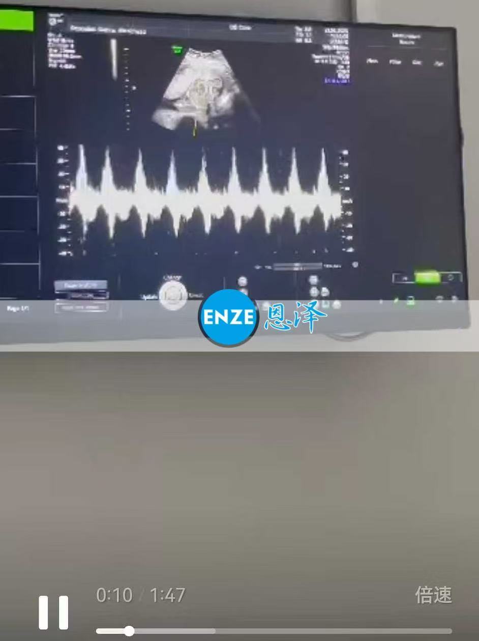 格鲁吉亚代孕代母21周产检顺利通过