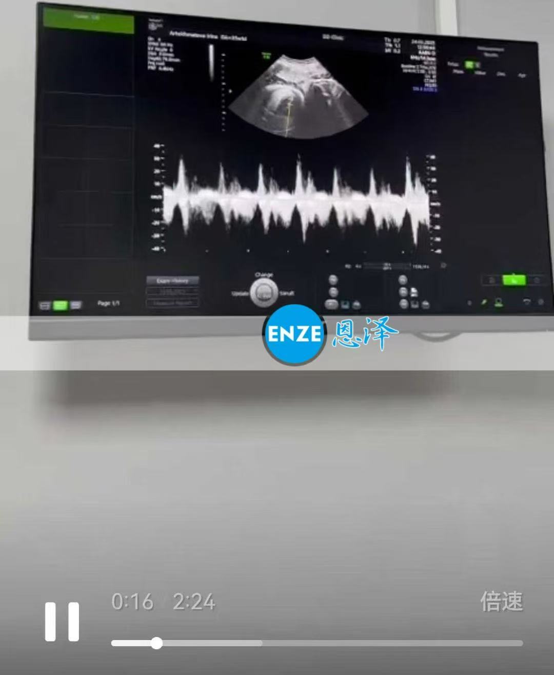格鲁吉亚代孕代孕代母即将迎接龙凤胎降生