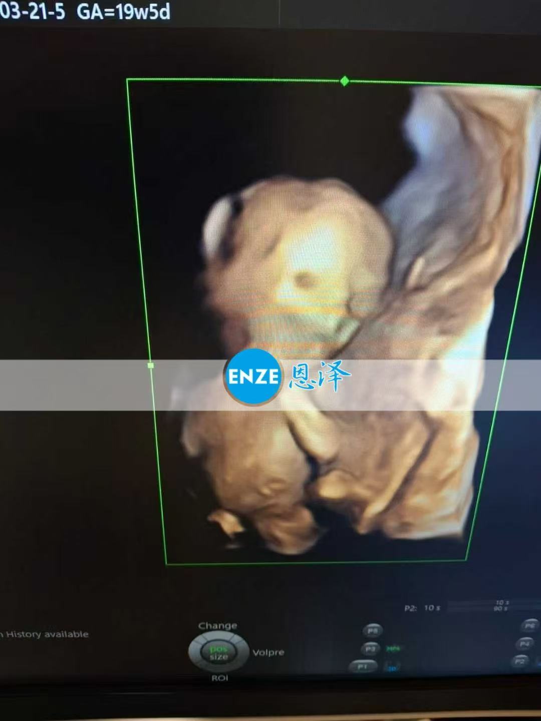 乌克兰代孕代孕代母19周产检顺利过关