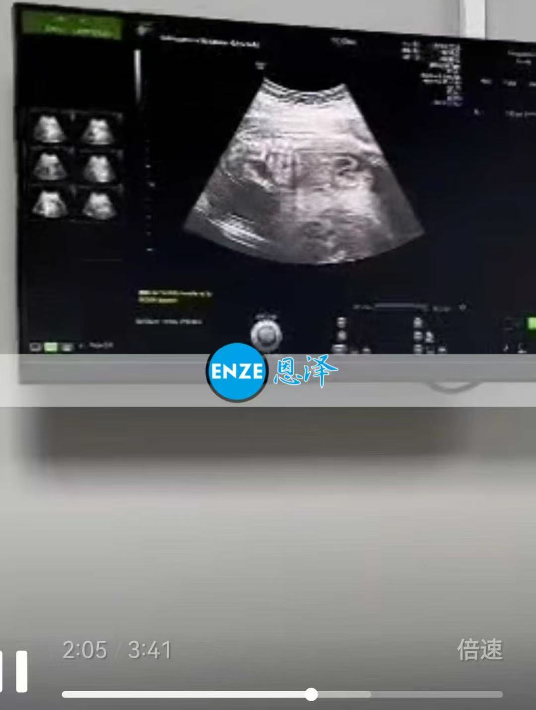 格鲁吉亚代孕代孕代母20周产检顺利通过