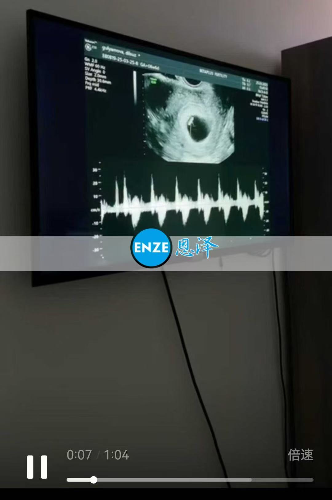 格鲁吉亚代孕代孕代母6周产检顺利通过