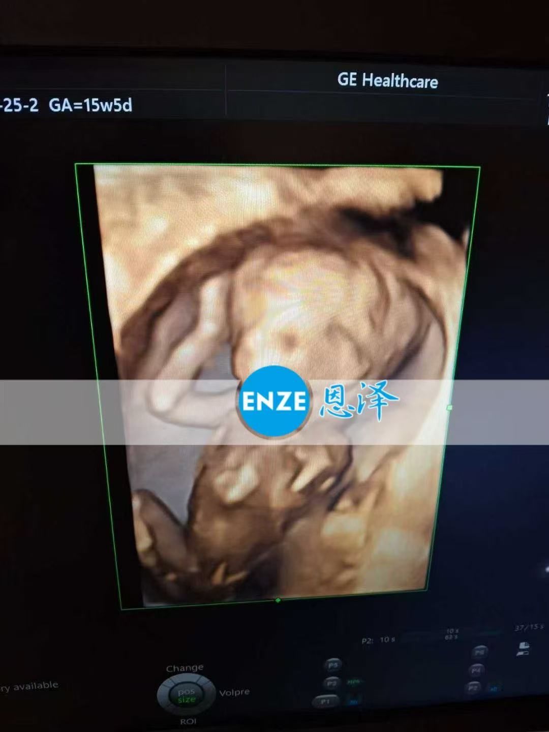 乌克兰代孕代孕代母顺利通过16周产检