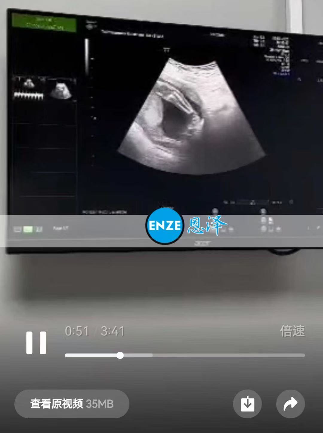 格鲁吉亚代孕代孕代母20周产检顺利通过