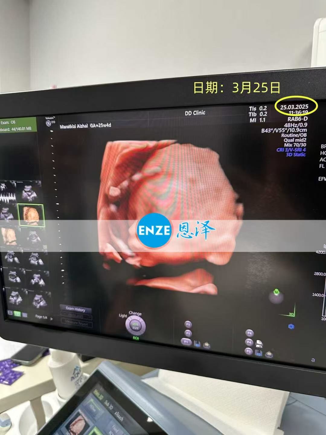 格鲁吉亚代孕代孕代母26周产检顺利通过