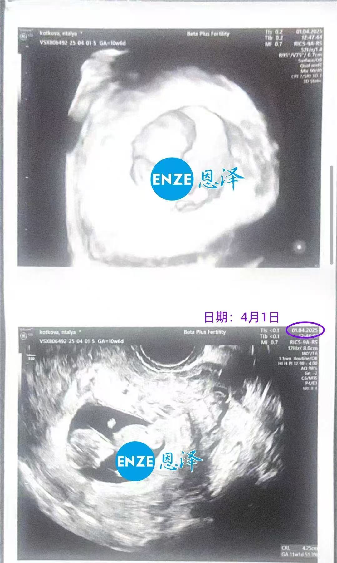 格鲁吉亚代孕代孕代母11周产检顺利过关