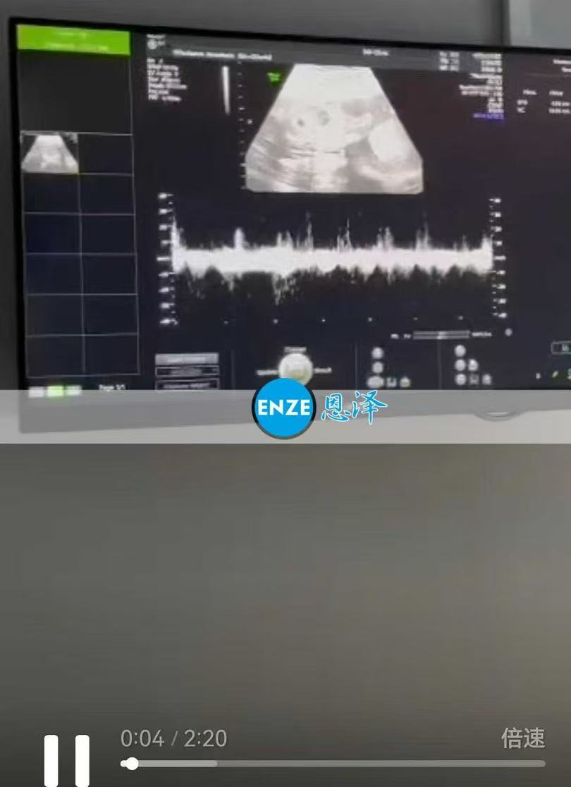 格鲁吉亚代孕代孕代母21周产检顺利通过