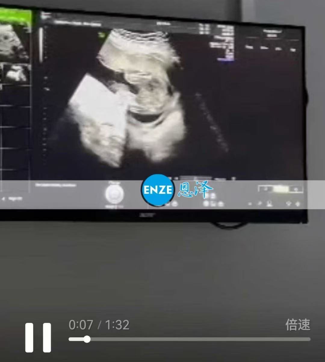 格鲁吉亚代孕代孕代母21周产检顺利过关