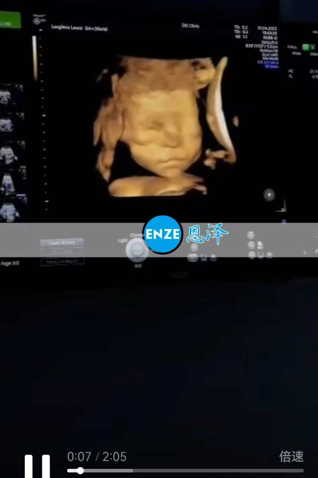 格鲁吉亚代孕代孕代母26周产检顺利通过