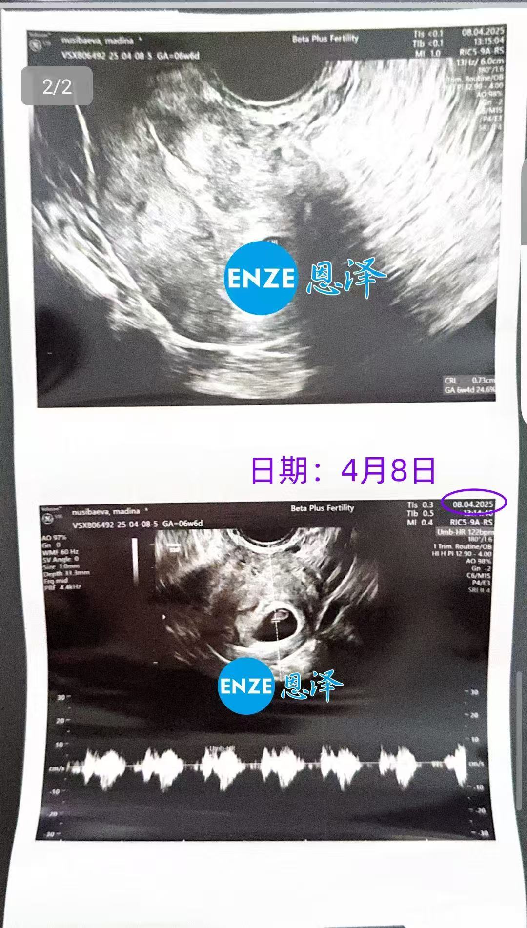 格鲁吉亚代孕代孕代母第一次产检顺利通过