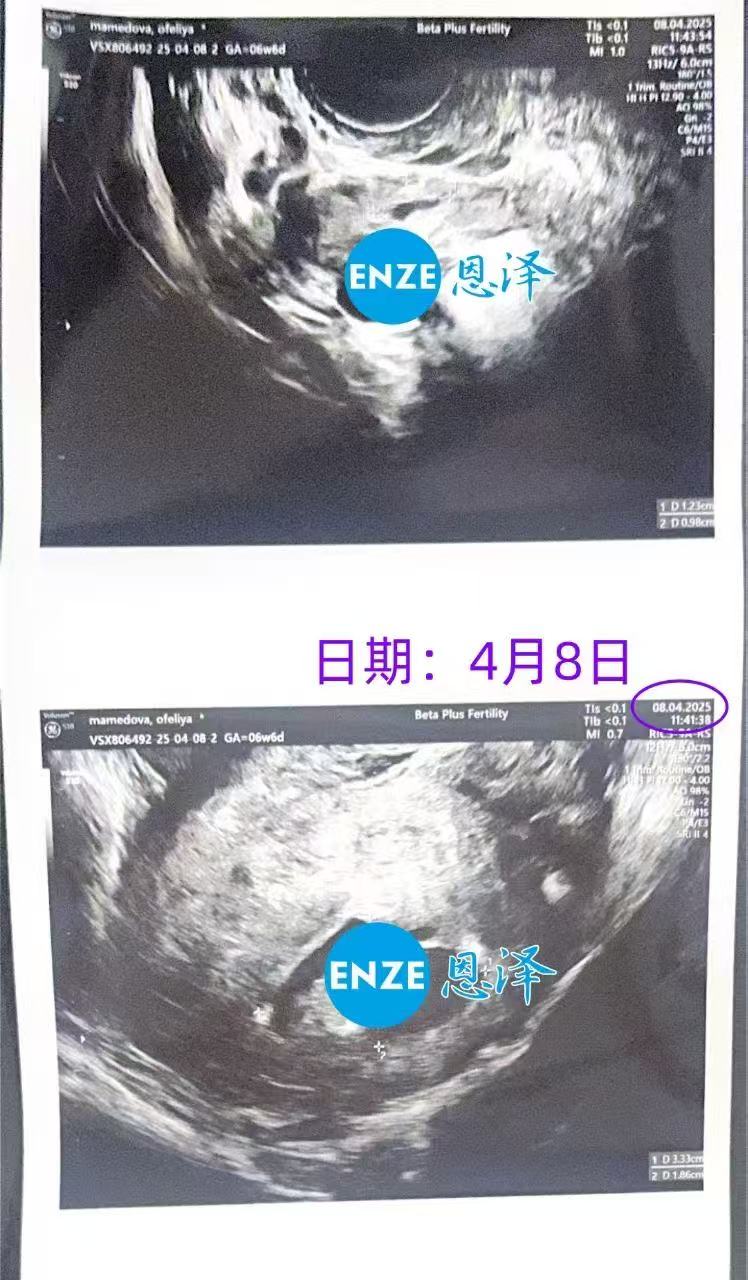 格鲁吉亚代孕代孕代母6周产检成功通过