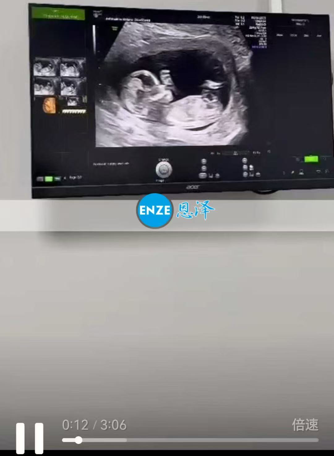格鲁吉亚代孕代孕代母顺利度过风险期