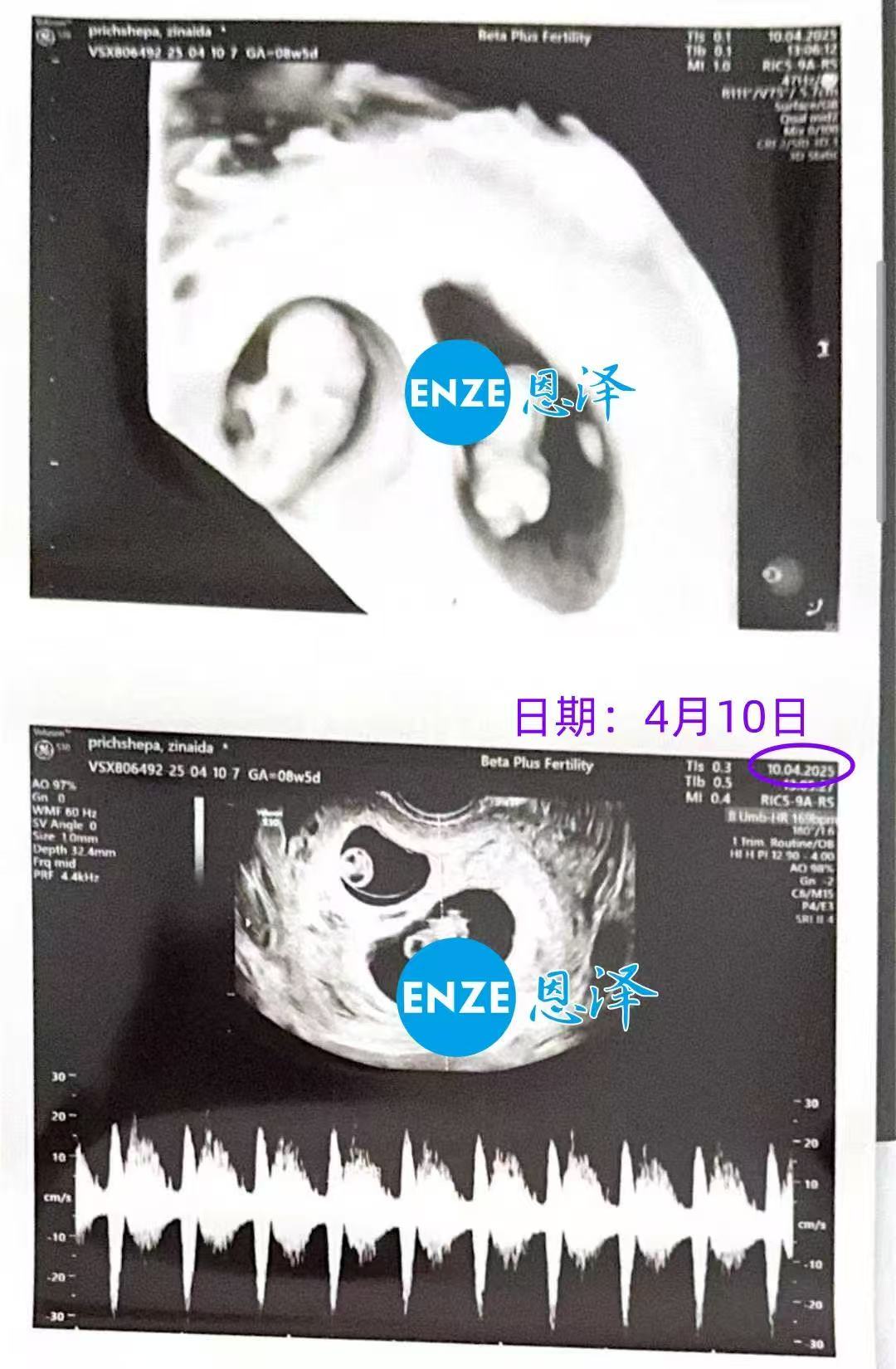 格鲁吉亚代孕代孕代母8周产检成功过关