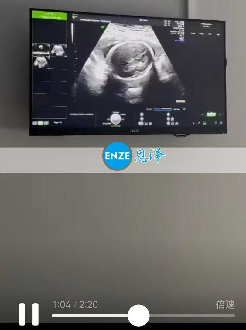 格鲁吉亚代孕代孕代母23周产检完美通过