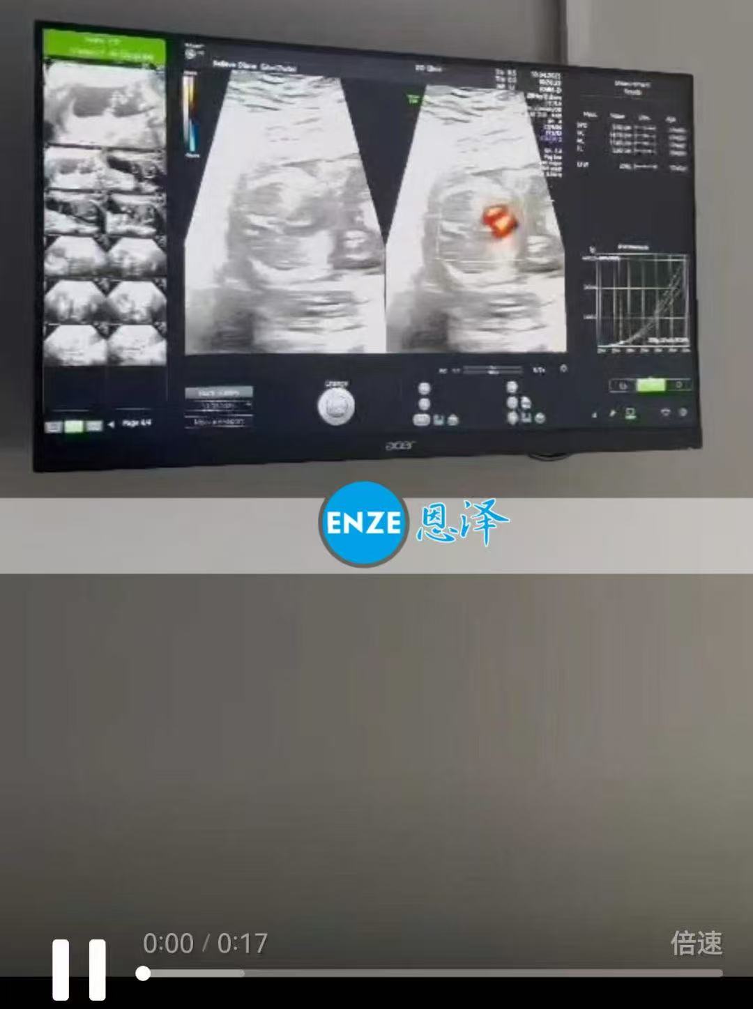 格鲁吉亚代孕代孕代母17周产检顺利完成