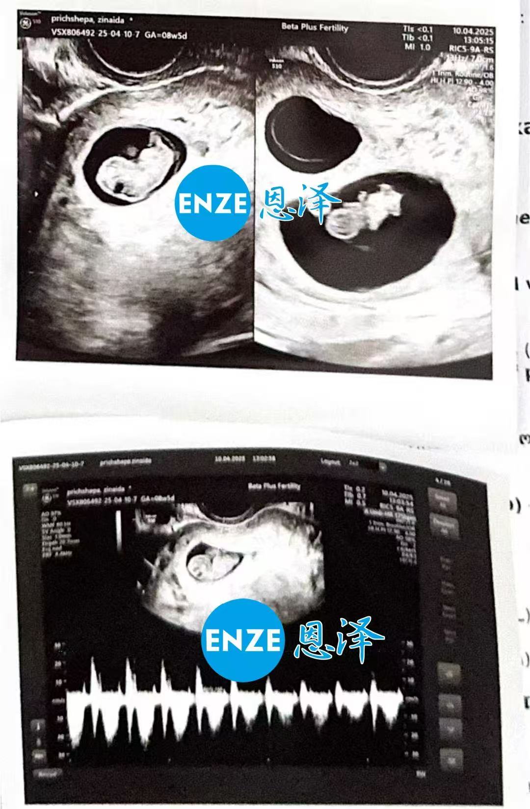 格鲁吉亚代孕代孕代母8周产检成功过关