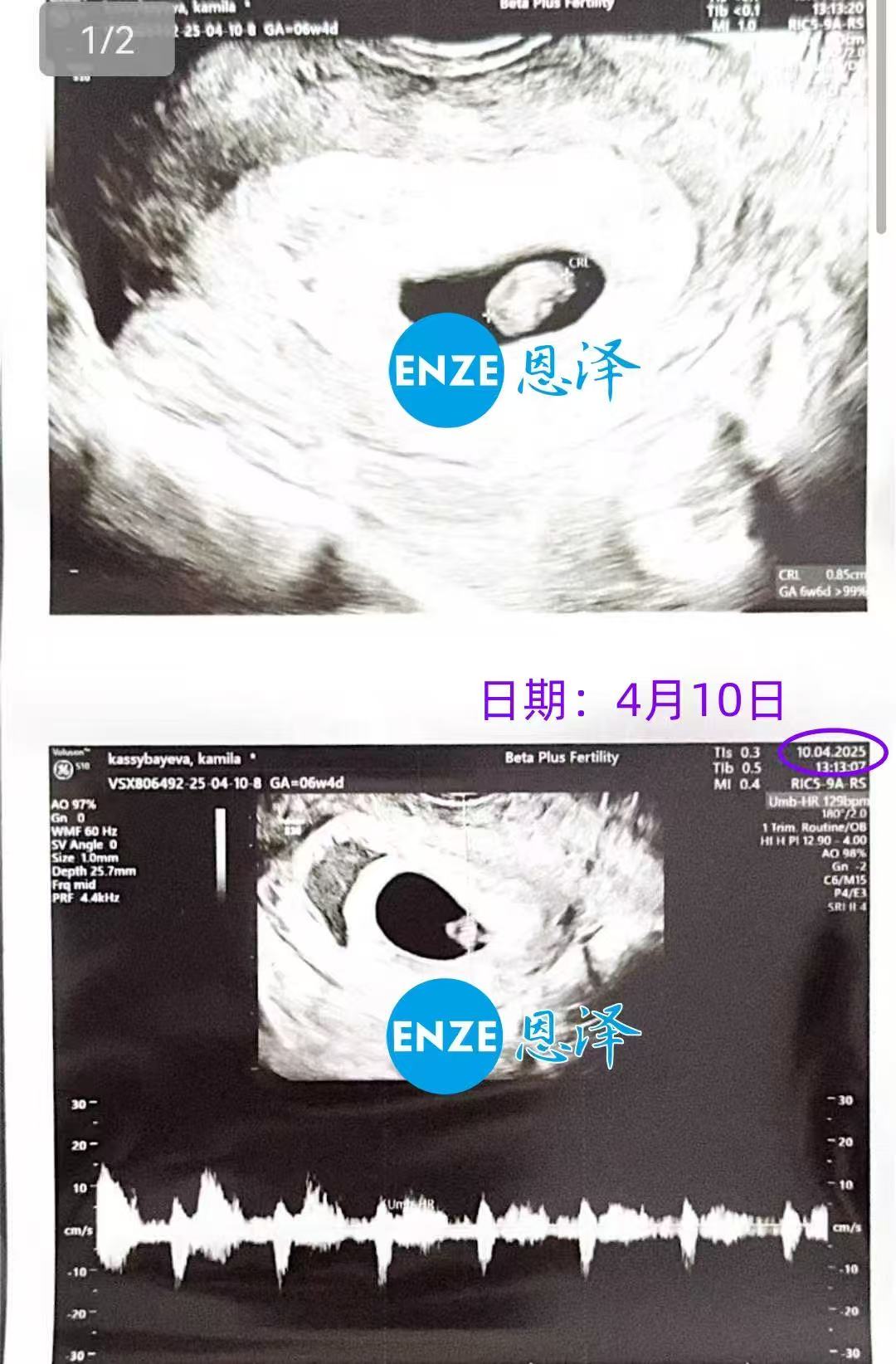 格鲁吉亚代孕代孕代母顺利通过6周首检