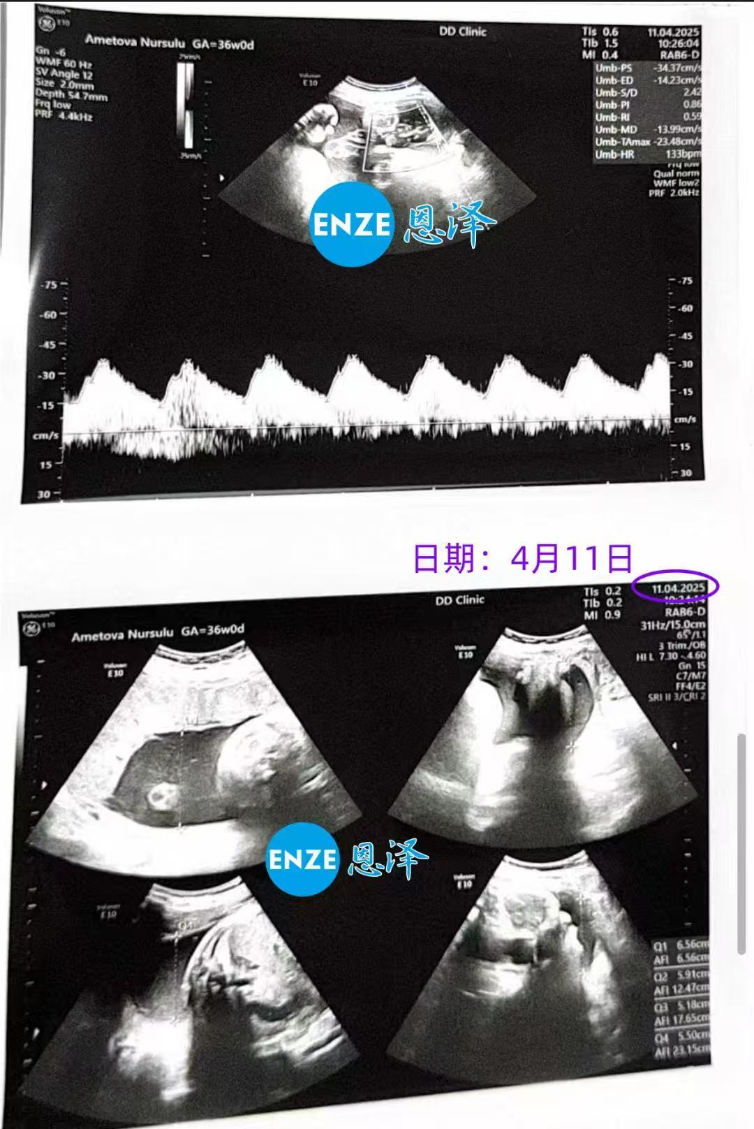格鲁吉亚代孕代孕代母36周产检通过，即将待产